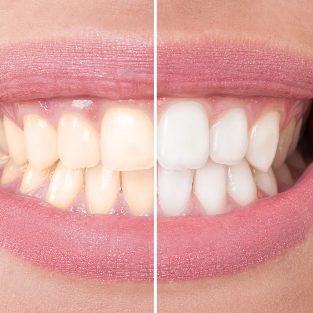 A side-by-side of a before and after image of the teeth whitening service at Battell Denture Clinic.