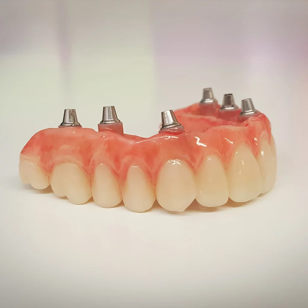 Photo of an implant-secured denture model with implant screws showing.