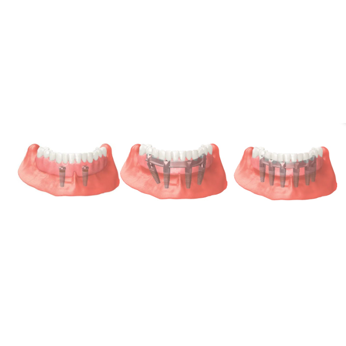 3D renderings of implant-secured dentures, showing the implants, the dentures, and the gums.
